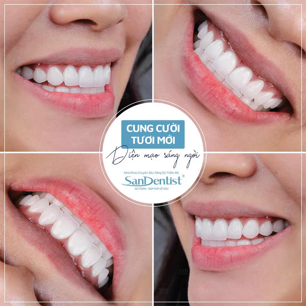 Cách khắc phục tình trạng răng cao răng thấp