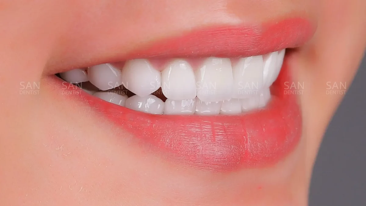 Cách khắc phục tình trạng răng cao răng thấp