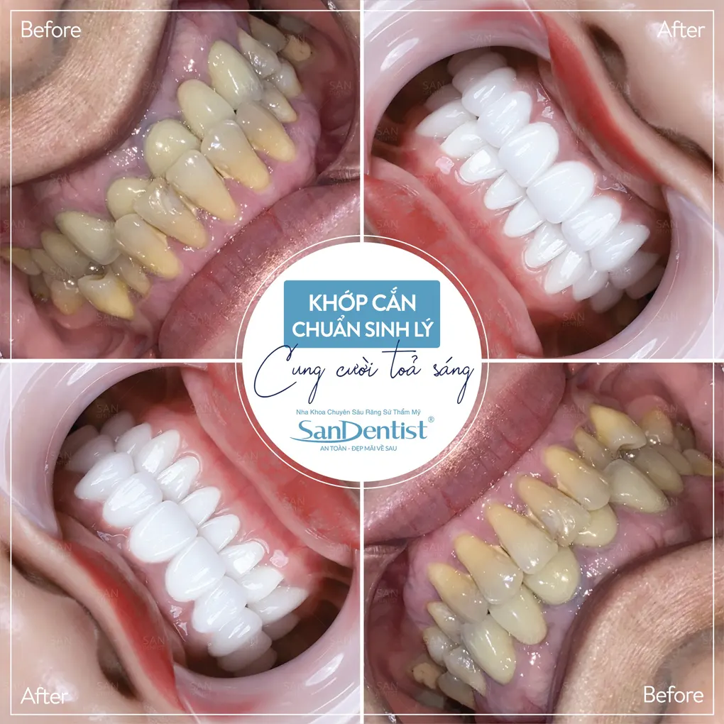 Cách khắc phục tình trạng răng cao răng thấp