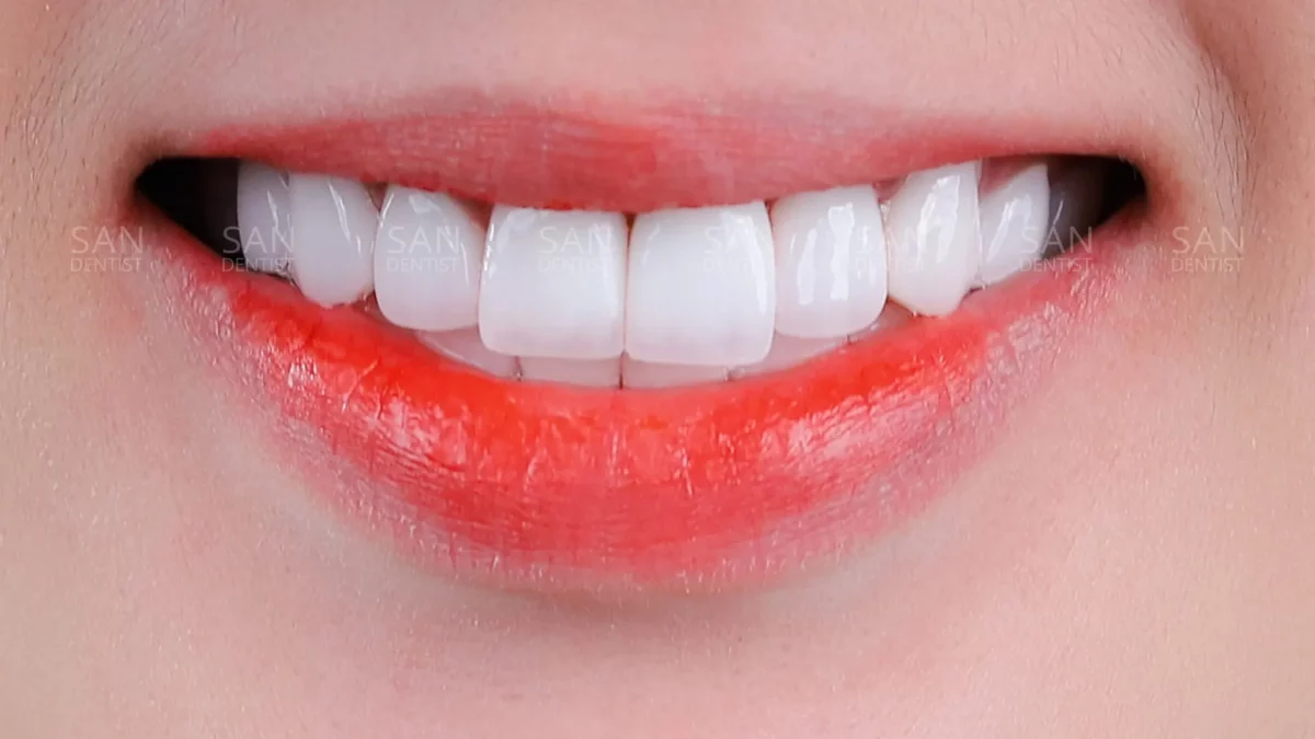 Cách nhận biết các loại răng giả cao cấp