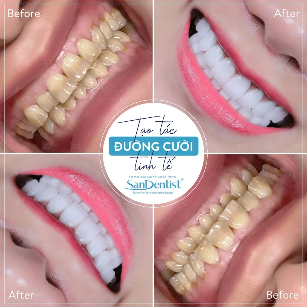 Cạo vôi răng siêu âm mang lại lợi ích gì?