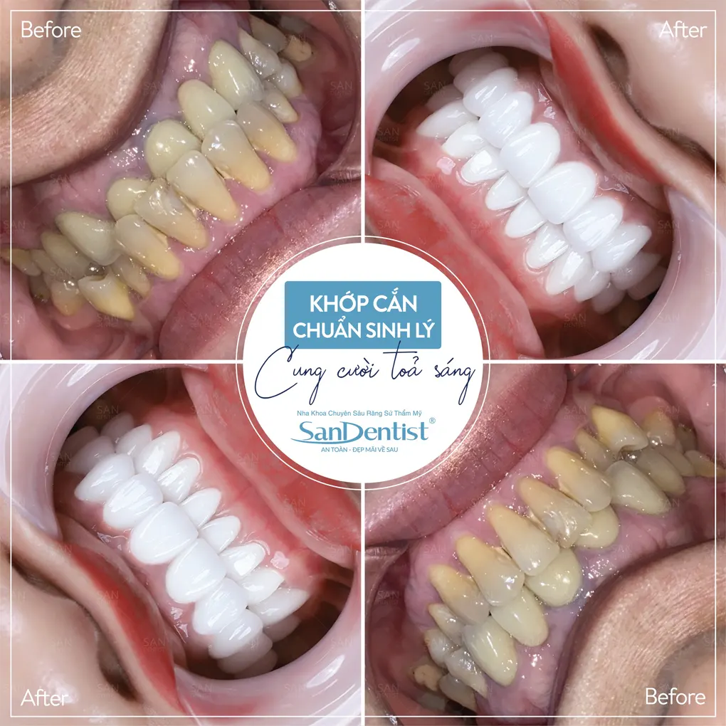 Công dụng của phương pháp hàn răng tạm thời