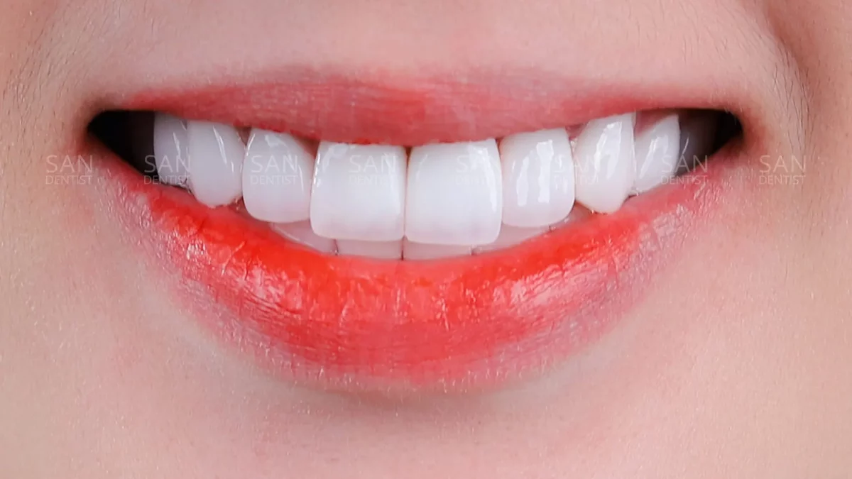 Điều trị viêm chân răng bằng thuốc nam từ dân gian