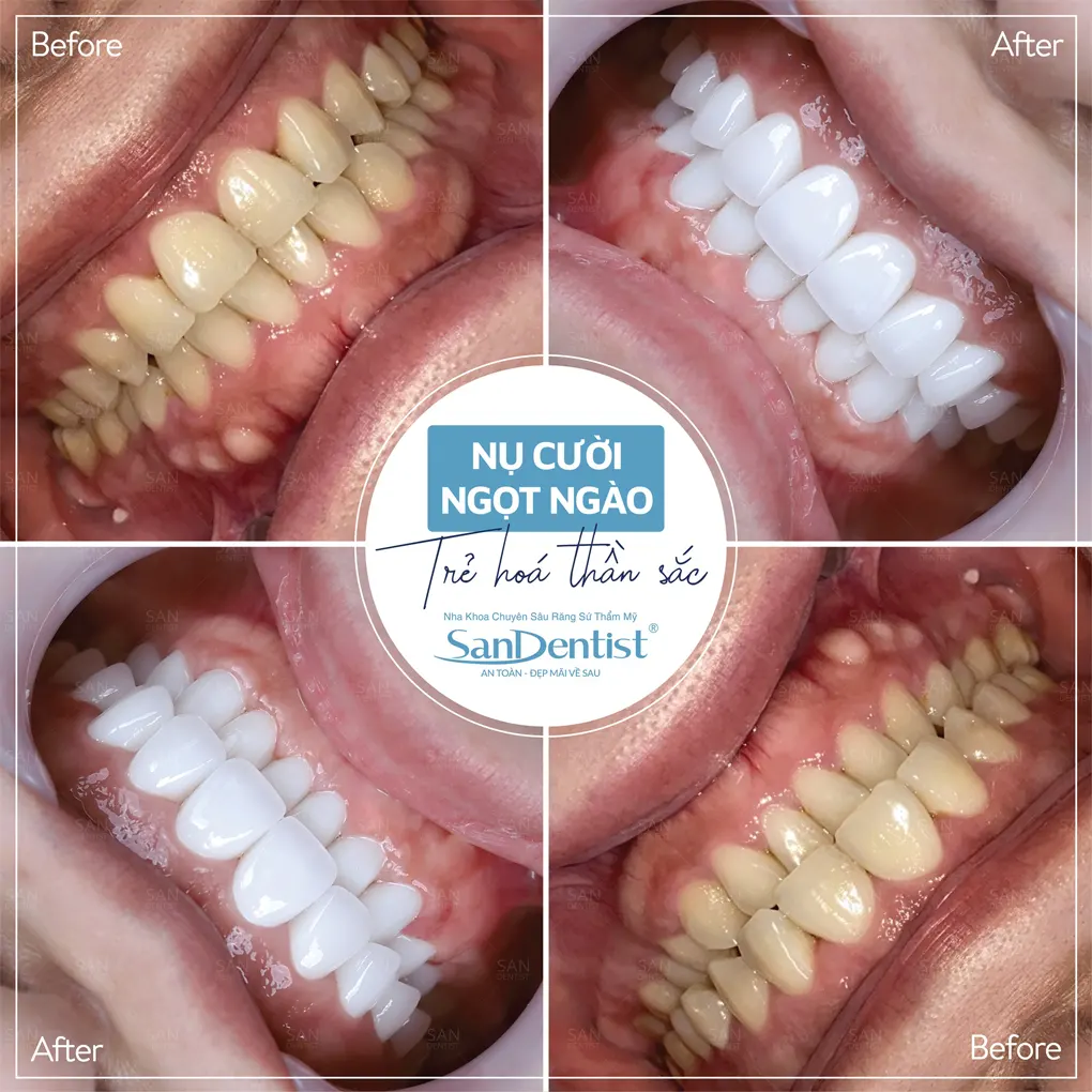 Kem đánh răng nào có thể điều trị cao răng?