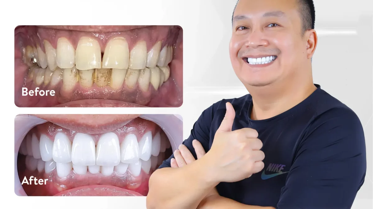 Những cách điều trị viêm lợi tụt lợi hiệu quả