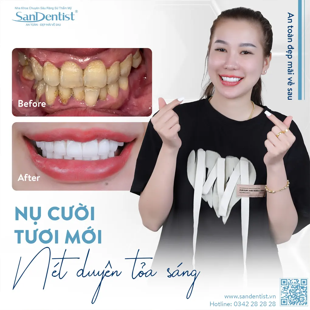 Phân biệt cao răng và mảng bám như thế nào?