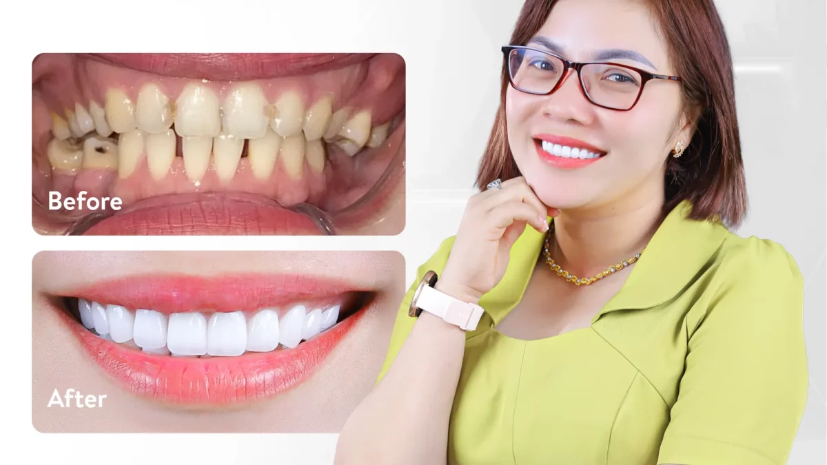 Phân biệt cao răng và mảng bám như thế nào?