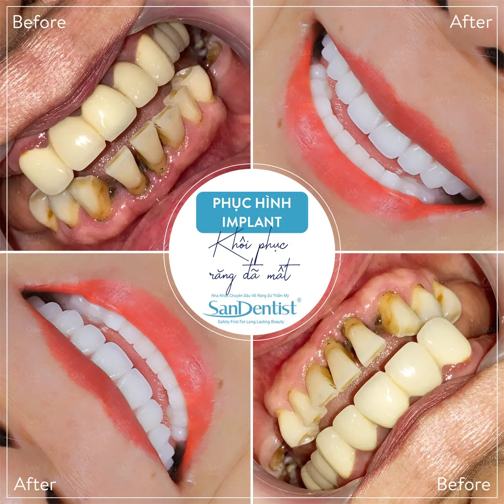 Phân biệt cao răng và mảng bám như thế nào?