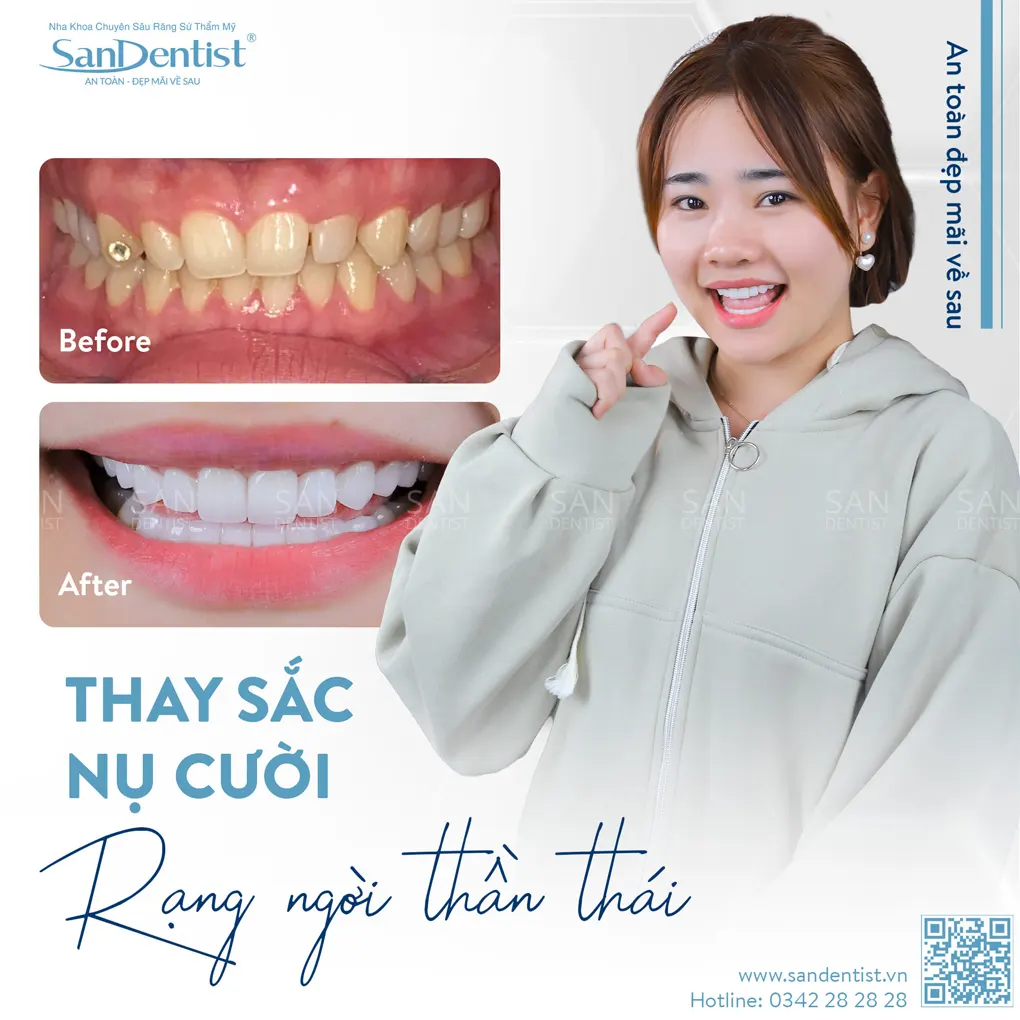 Tại sao sâu răng phải lấy tủy nhiều lần?