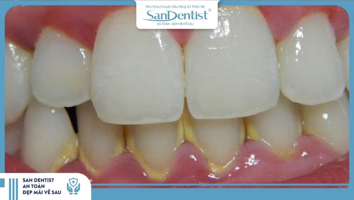Thời gian lấy cao răng định kỳ cho răng sứ phụ thuộc vào loại răng sứ sử dụng