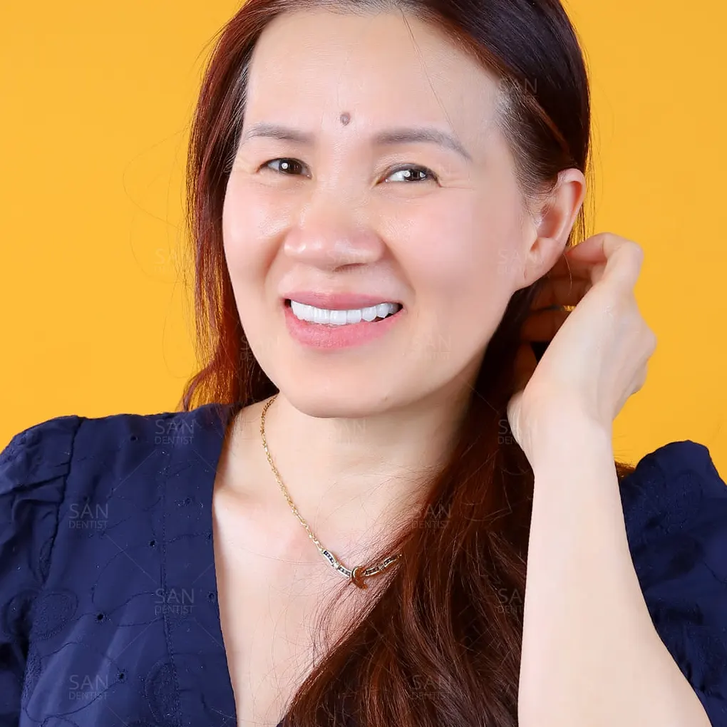 Trám răng mẻ có bền không?