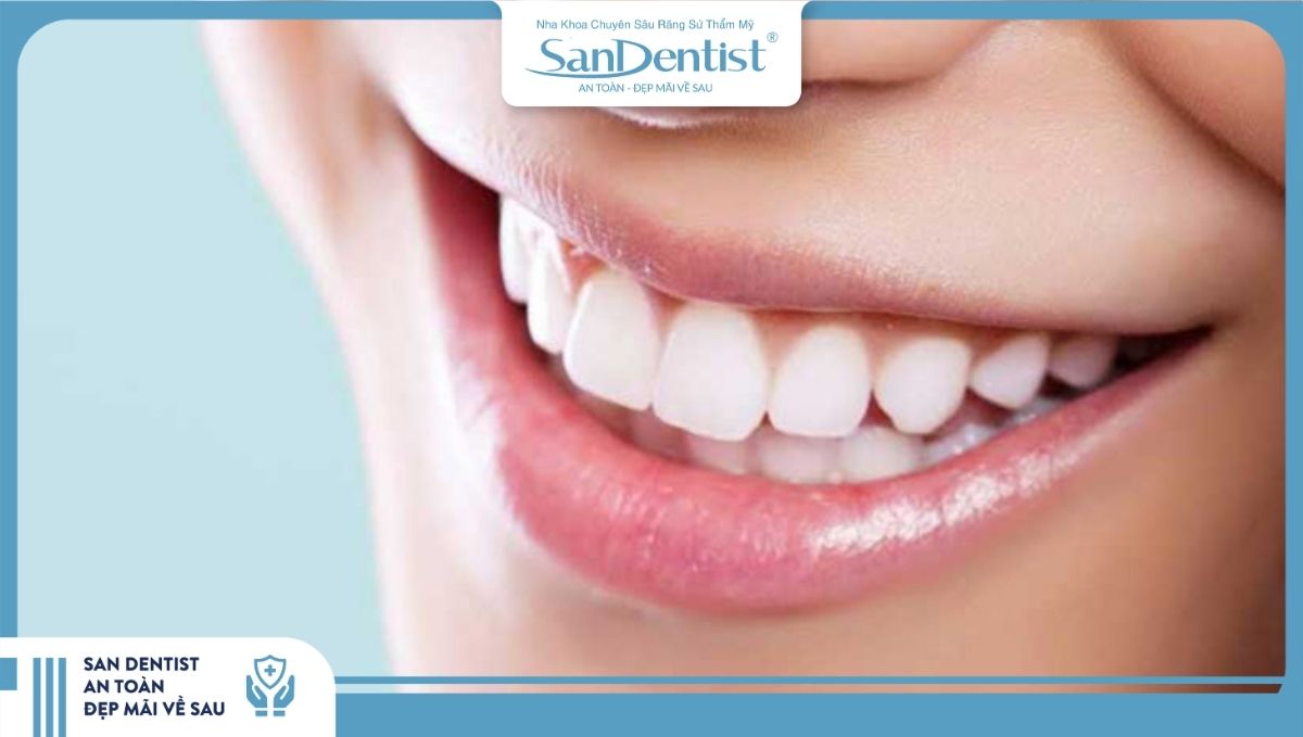 Làm răng sứ 4 răng cửa là lựa chọn đáng cân nhắc nếu bạn muốn có hàm răng sứ đẹp
