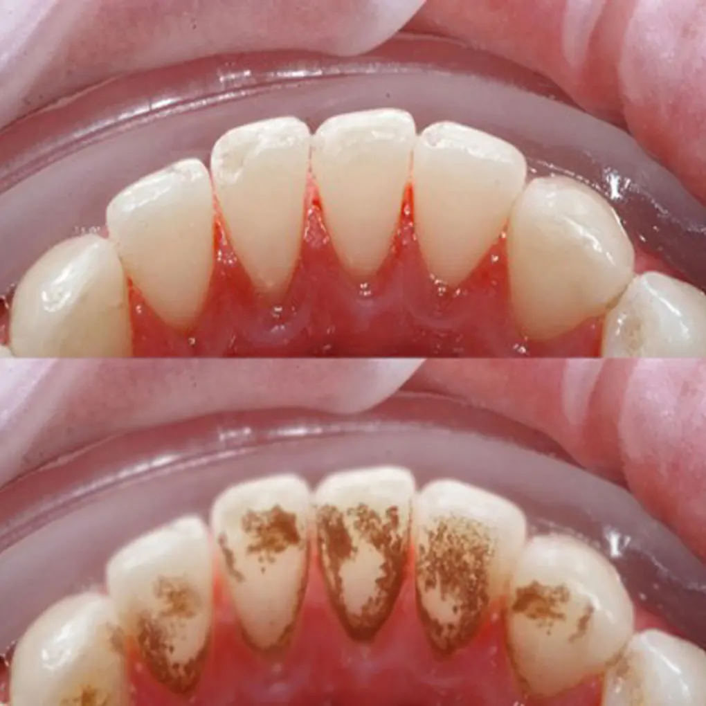 Những nguy cơ khi điều trị cao răng tại nhà