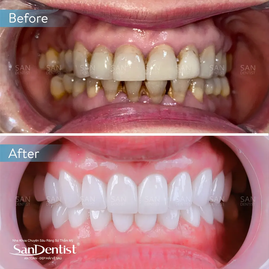 Bí quyết điều trị hôi miệng bằng mật ong