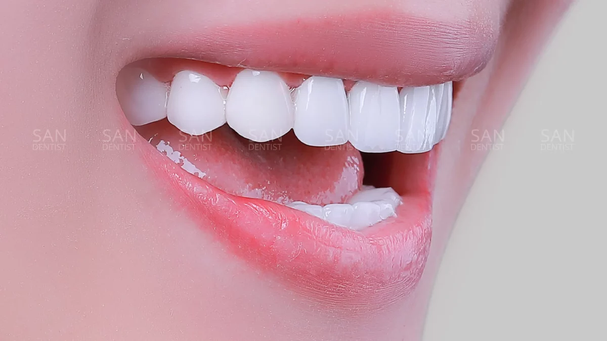 Cách lựa chọn màu sắc của răng sứ