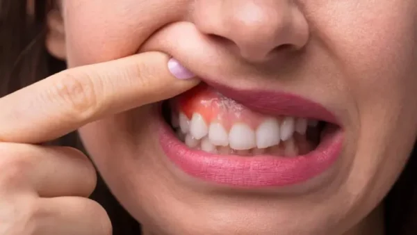 Cách xử lý tình trạng ngứa nướu răng lâu ngày