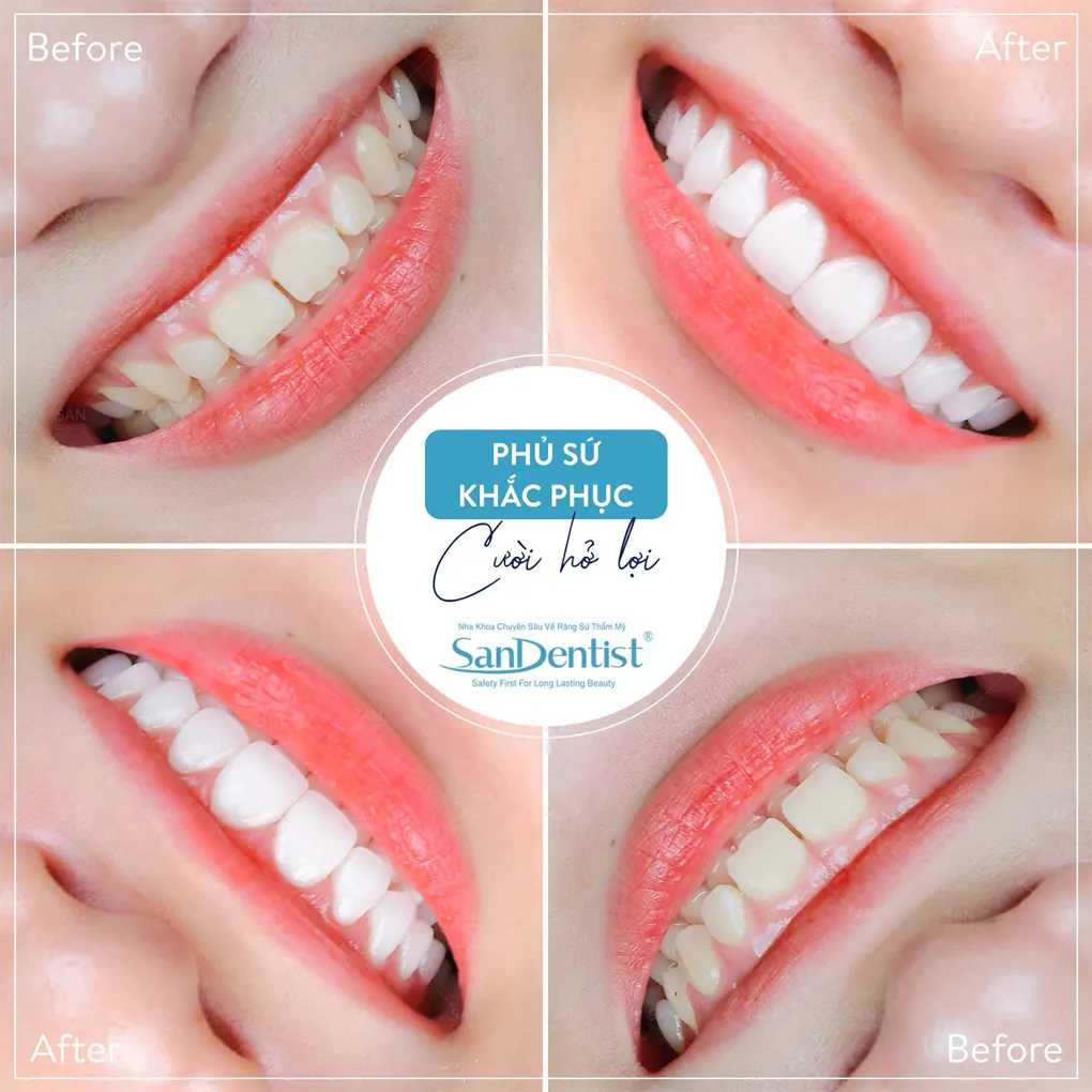 Cứng hàm: Nguyên nhân và cách điều trị