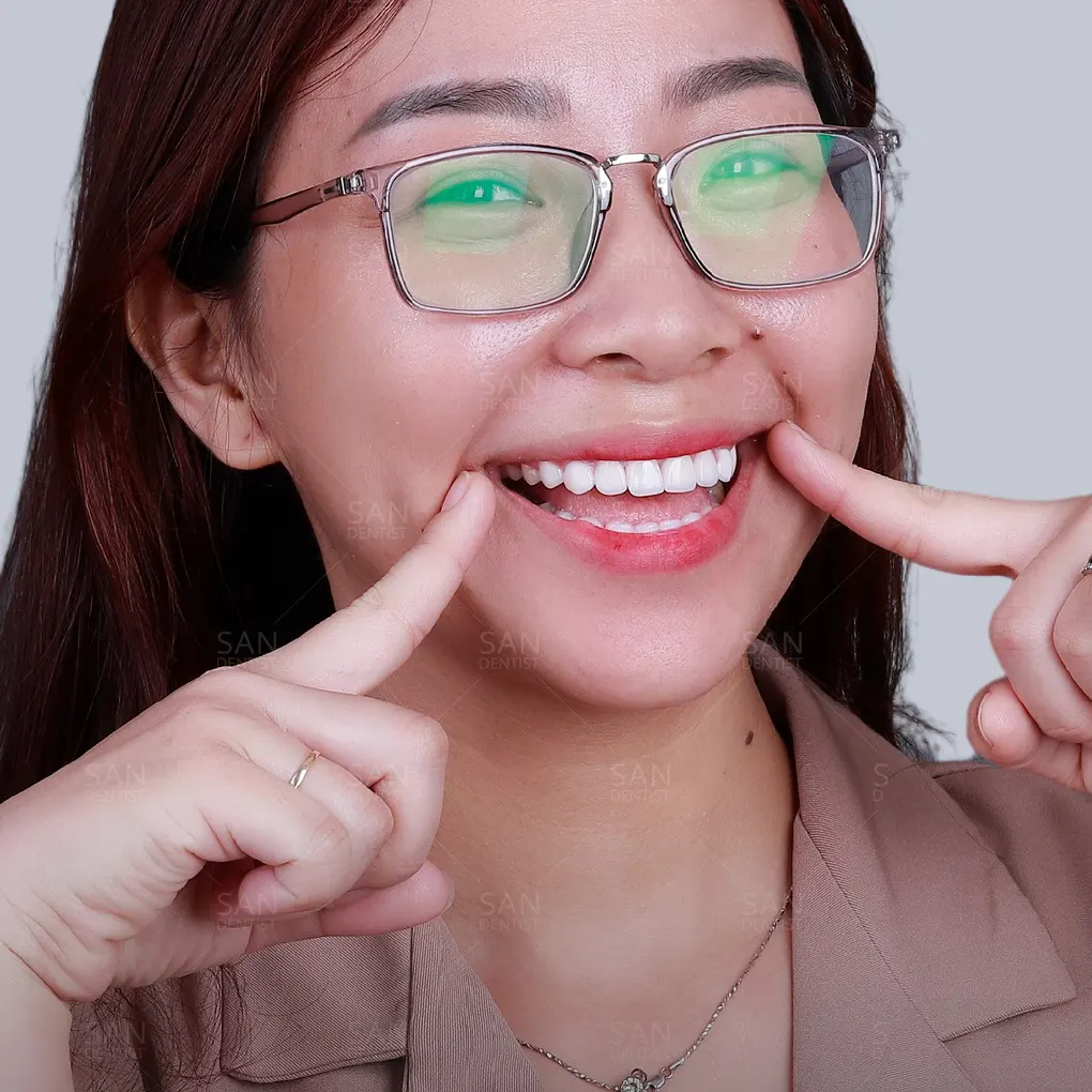 Dán sứ Veneer Emax có giá bao nhiêu?