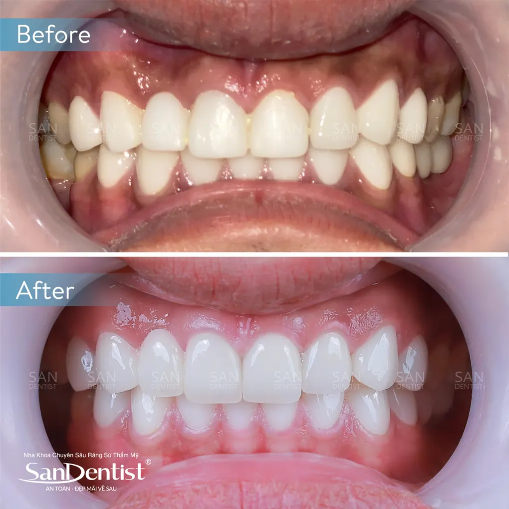 Dán sứ Veneer sai kỹ thuật nguy hiểm như thế nào? 