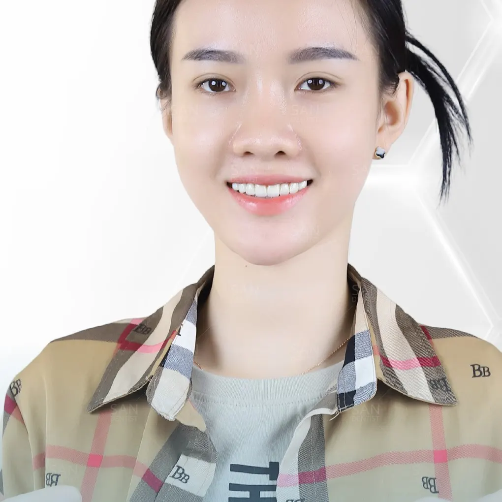 Dán sứ Veneer sai kỹ thuật nguy hiểm như thế nào? 