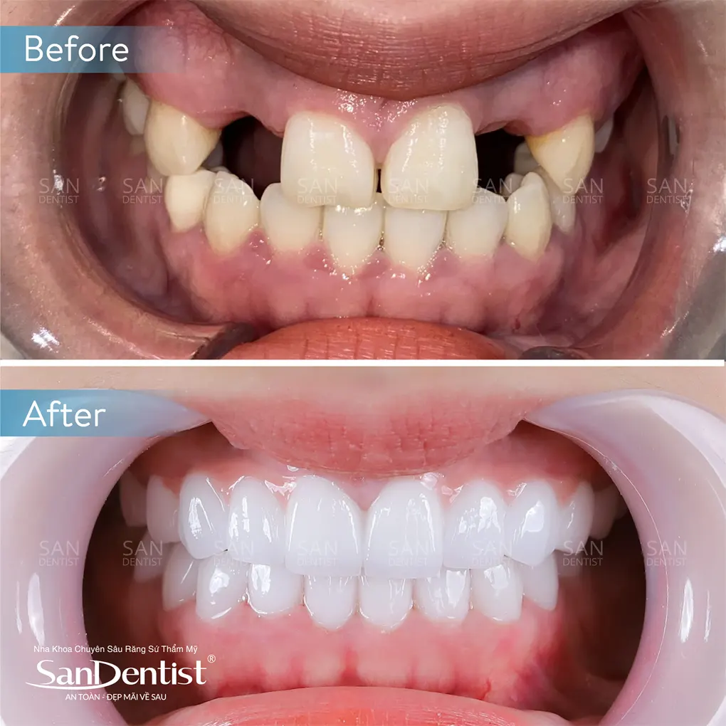 Dự đoán tuổi thọ thông qua số lượng mất răng