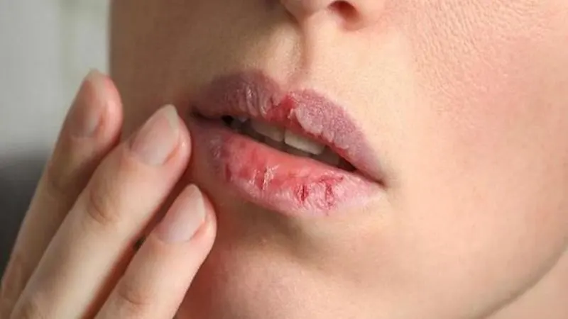 Khô miệng kéo dài: Làm sao để khắc phục?