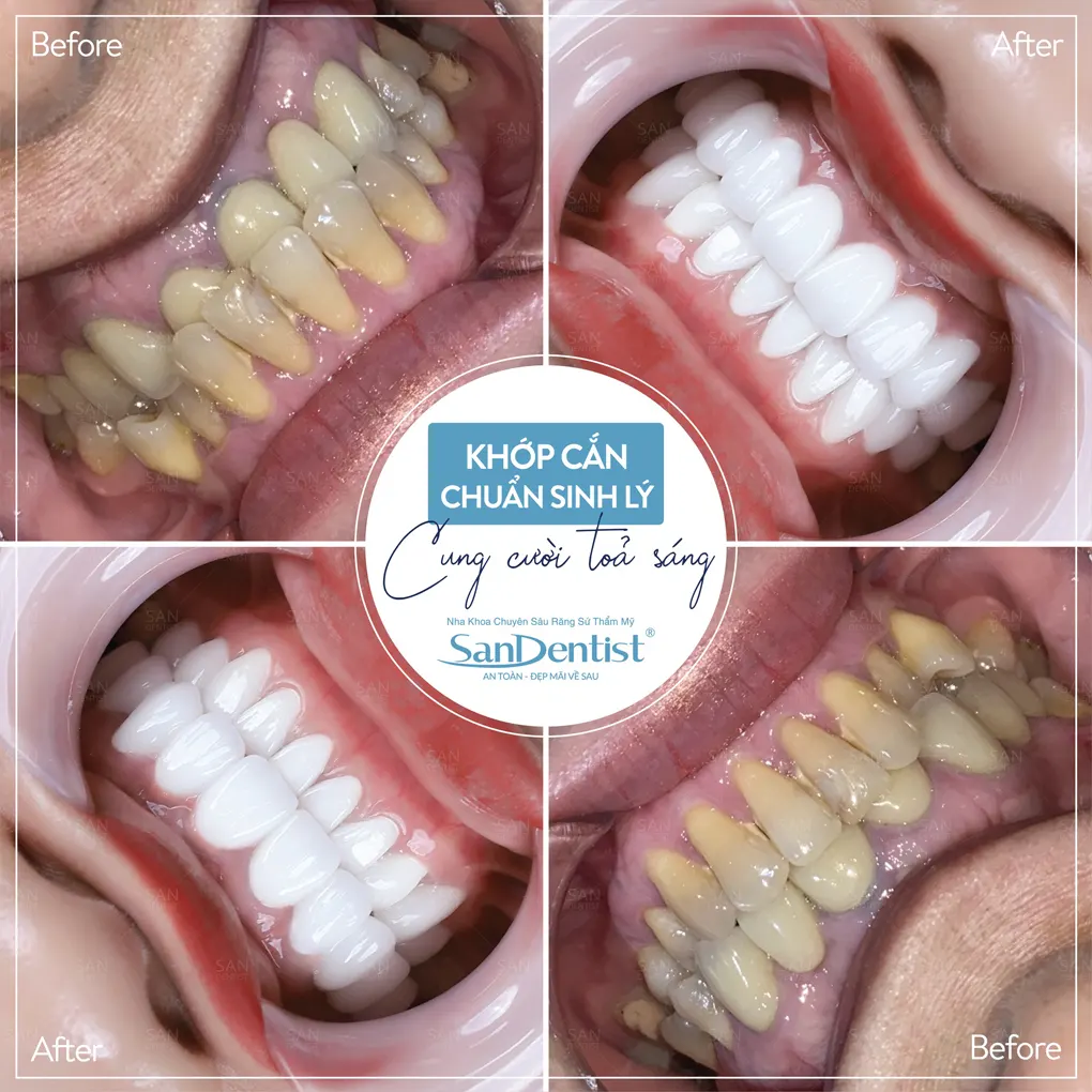 Những điều cần biết về tình trạng răng bị đen