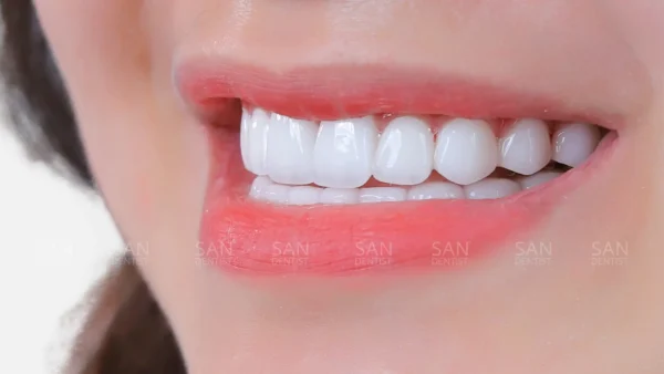 Những điều cần biết về tình trạng răng bị đen