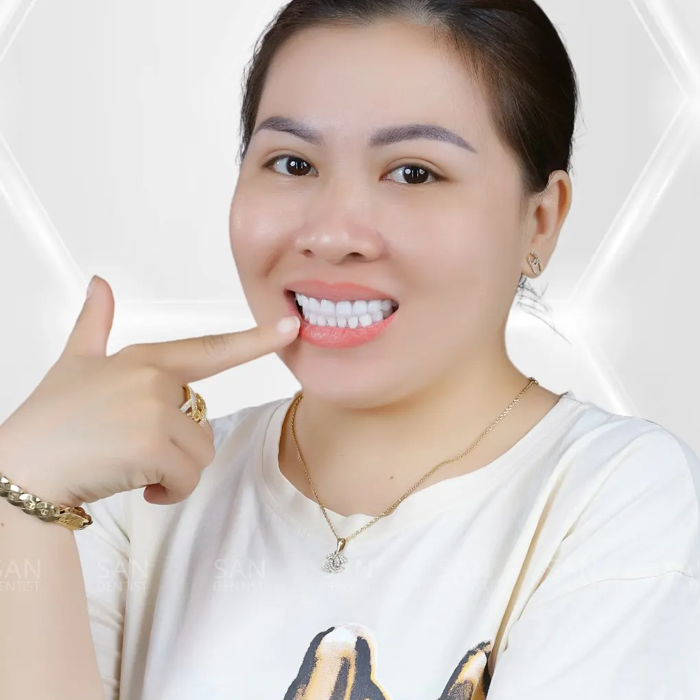 Phẫu thuật cười hở lợi khoảng bao nhiêu tiền?