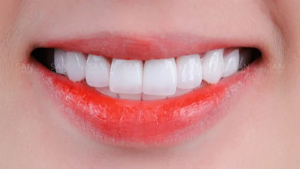 Phẫu thuật cười hở lợi khoảng bao nhiêu tiền?