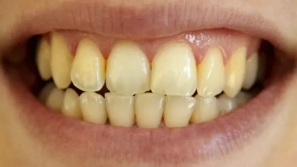 Tại sao đánh răng thường xuyên mà răng vẫn vàng