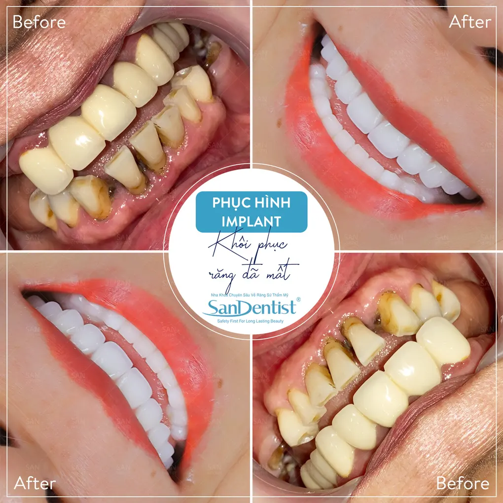 Tẩy trắng răng có làm răng bị nhạy cảm? 