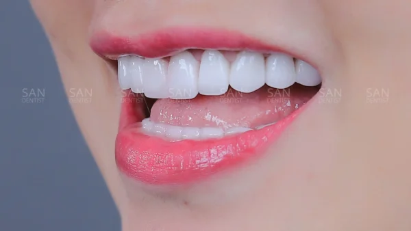 Tẩy trắng răng có làm răng bị nhạy cảm?