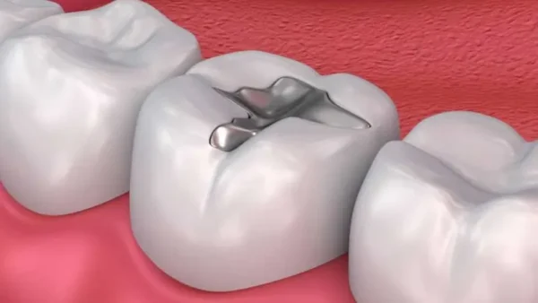 Trường hợp không nên hàn răng bằng amalgam