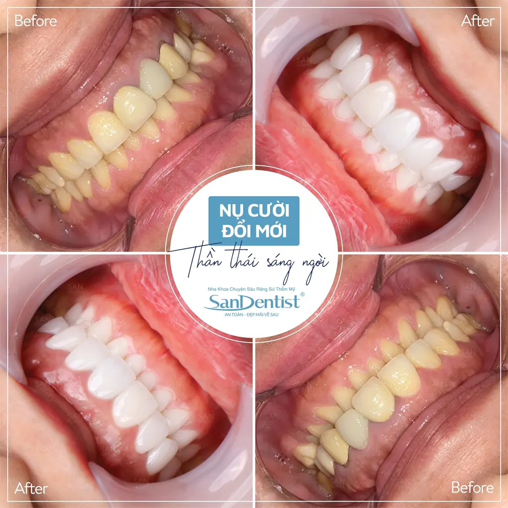 Trường hợp không nên hàn răng bằng amalgam