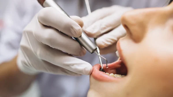 5 biến chứng sau nhổ răng không nên xem nhẹ!