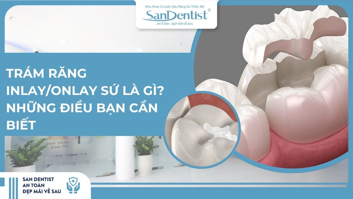 Trám răng InlayOnlay sứ là gì Những điều bạn cần biết
