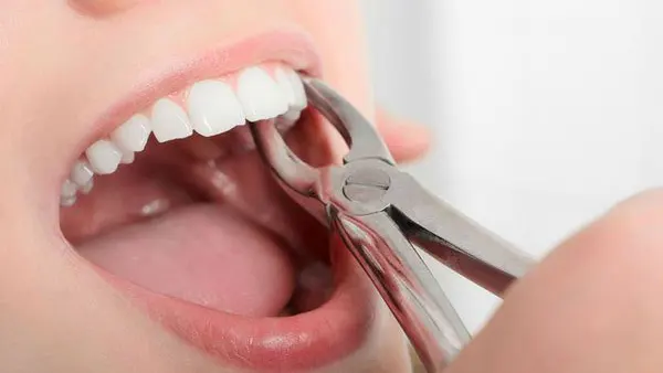 Bỏ túi ngay 4 mẹo cầm máu sau nhổ răng