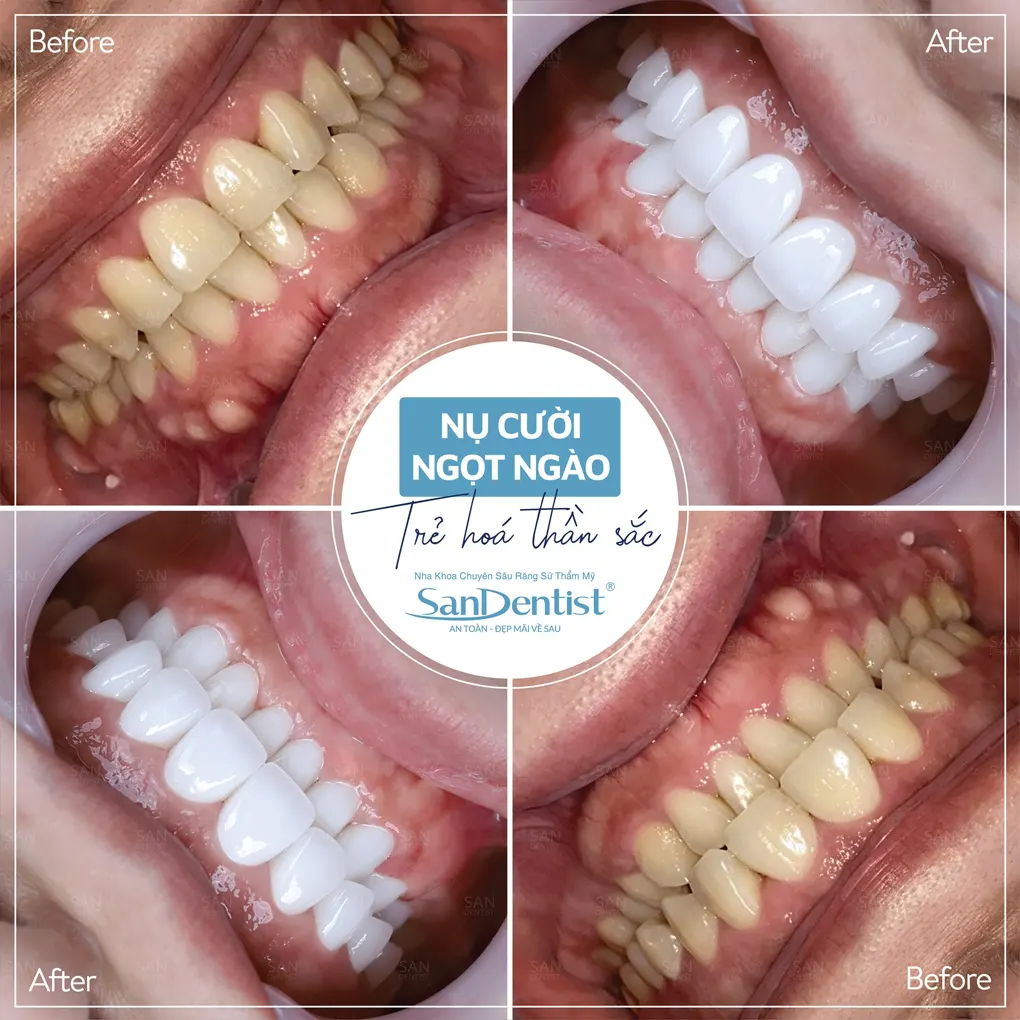 Điểm mặt những thói quen khiến răng bị ố vàng