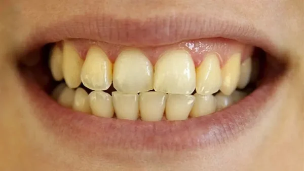 Điểm mặt những thói quen khiến răng bị ố vàng