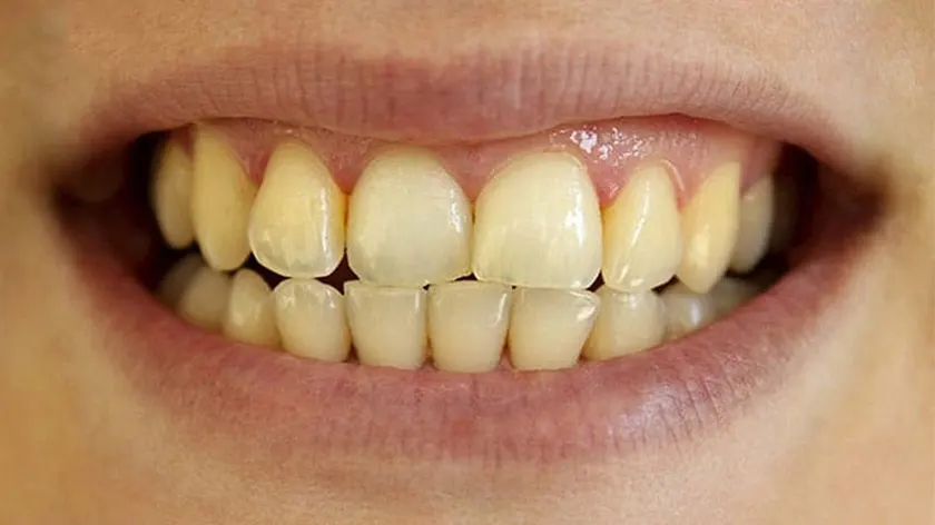 Điểm mặt những thói quen khiến răng bị ố vàng