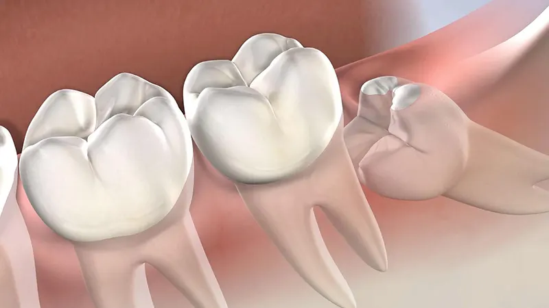 Điều cần lưu ý khi nhổ răng khôn mọc lệch