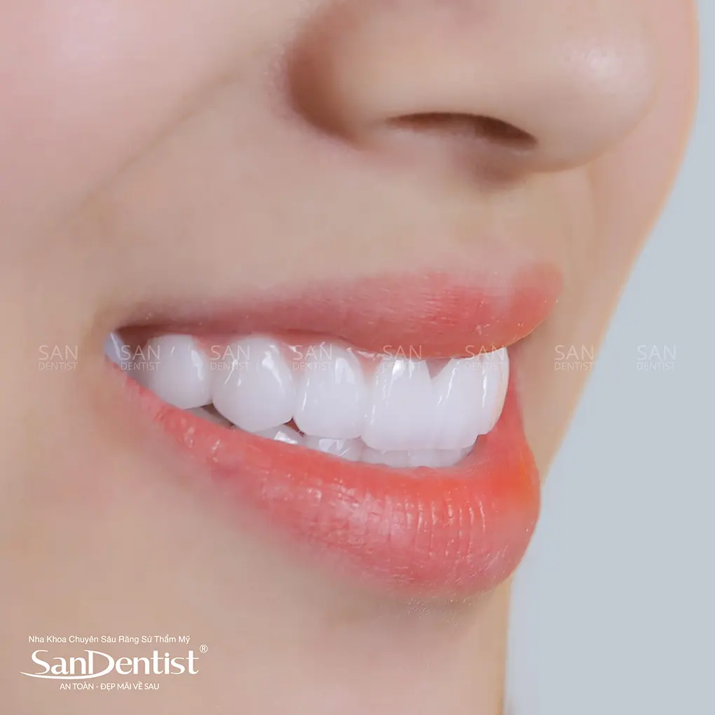 Điều cần lưu ý khi nhổ răng khôn mọc lệch