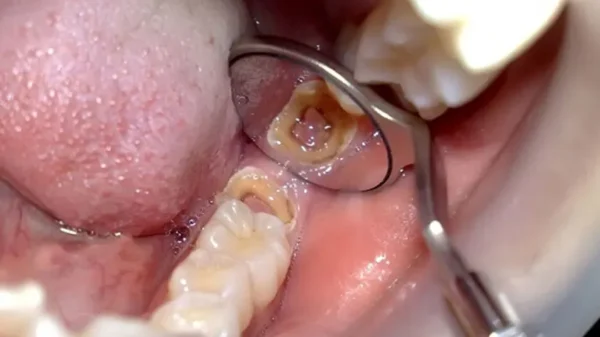 Khi nào nhổ răng sâu và những lưu ý quan trọng?