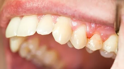 Nạo túi nha chu: Biện pháp điều trị viêm quanh răng