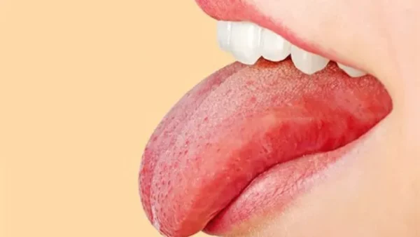 Nên làm gì khi bị chảy máu lưỡi?