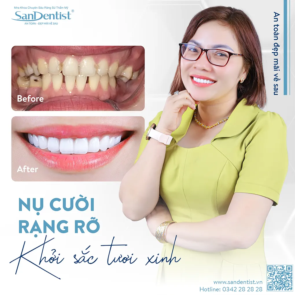 Những điều cần biết về bệnh viêm nướu răng khôn