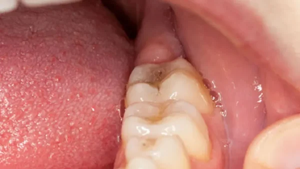 Những điều cần biết về bệnh viêm nướu răng khôn