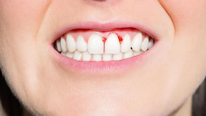 Nướu răng sưng đỏ, đau nhức kéo dài cảnh báo điều gì?