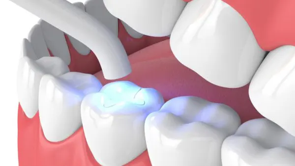 Phương pháp hàn cổ răng: Ưu và nhược điểm